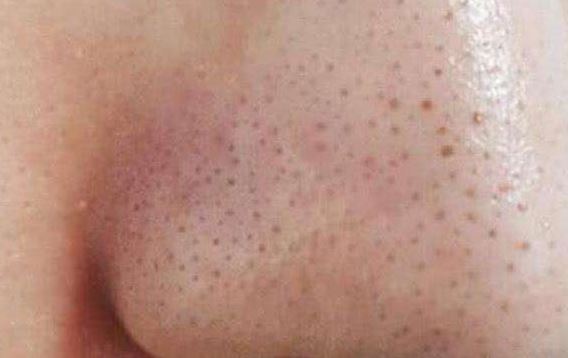 清潔面膜哪個牌子可以快速祛黑頭？趙薇、薇婭 推薦的紐西之謎泥膜真的好用嗎？